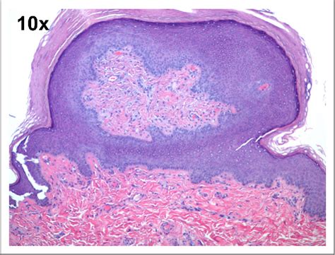 papule penienne|Management of Pearly Penile Papules: A Review of the Literature